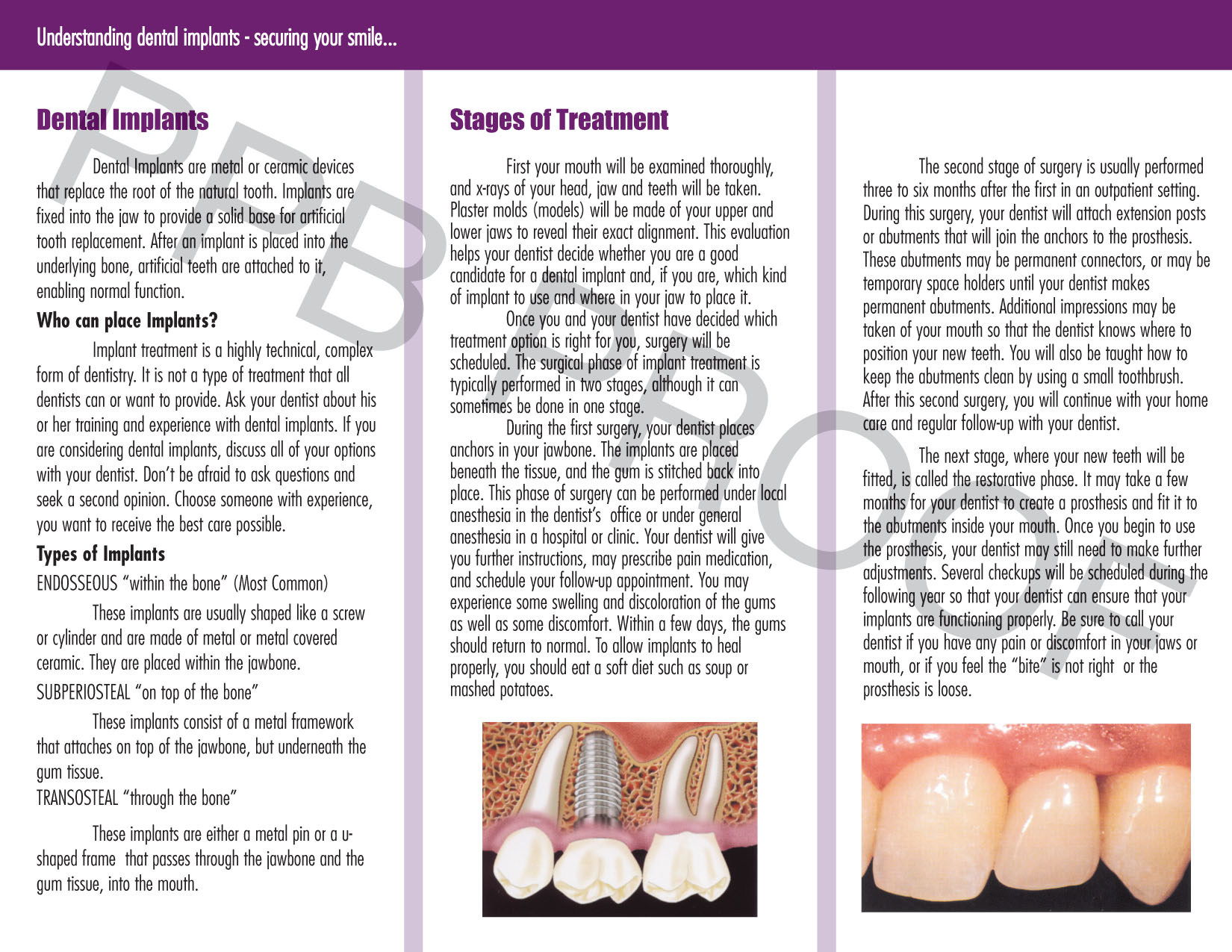 Dental Implants - Click Image to Close
